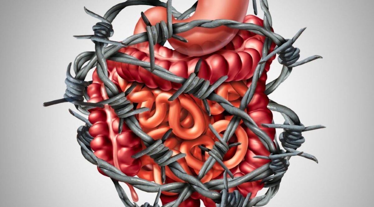 Read more about the article Sindromul intestinului iritabil – simptome si tratament
