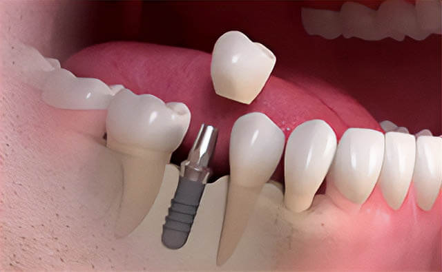 Read more about the article 8 răspunsuri despre implanturile dentare oferite de Total Dent Sibiu