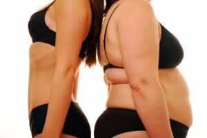 Read more about the article Rezecția gastrică pentru scăderea în greutate