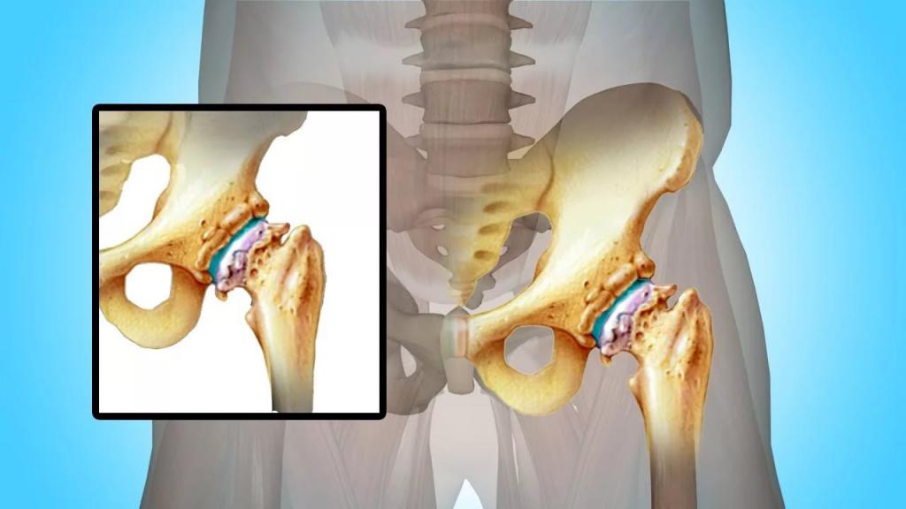 Read more about the article Ce cauzează uzura articulației șoldului și cum poate fi evitată?