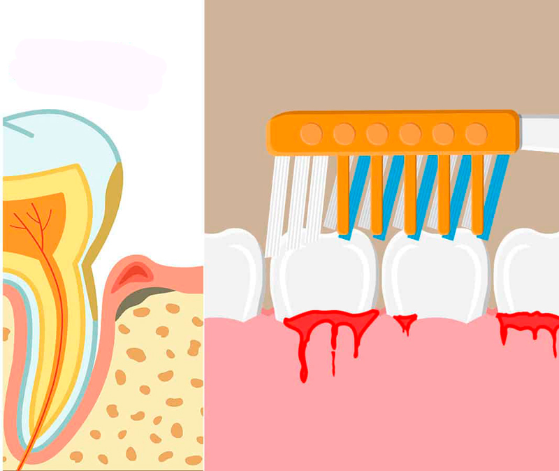 You are currently viewing De ce sângerează gingiile și cum să le tratezi