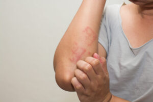 Read more about the article Ce este dermatita atopică și cum știi dacă o ai?