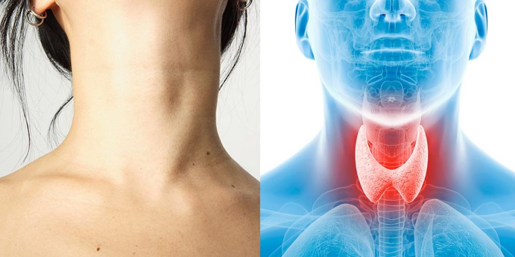 Read more about the article Glanda tiroidă mărită: Cauze, simptome și tratament