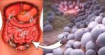 Candidoza intestinală: cauze, simptome și tratament