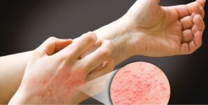 Read more about the article Eczema: Tratament cu remedii naturale (rețeta)