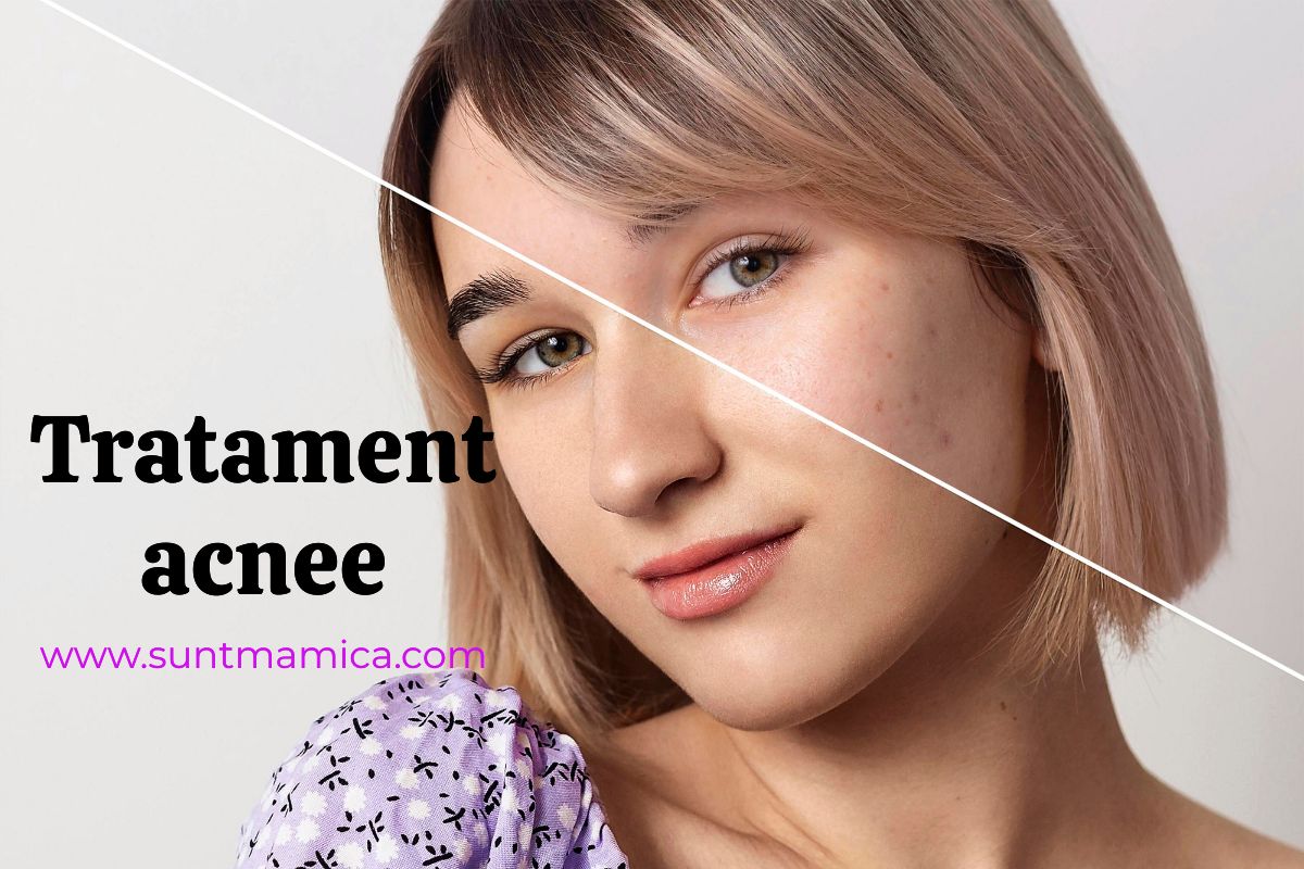 Read more about the article Acnee pe față, Ce Vitamine Lipsesc? Tratament pentru acnee
