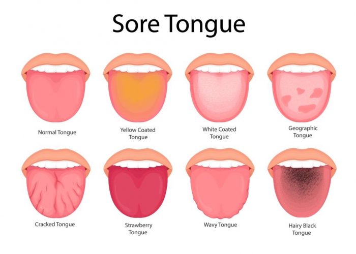 boli ale limbii
