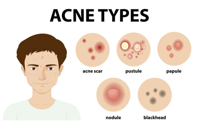 Tipuri de acnee