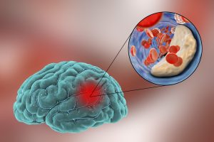 Read more about the article Mini accident vascular cerebral: simptome, cauze și prevenire