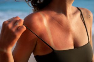 Read more about the article Cum să nu tratezi arsurile solare dacă nu vrei să-ți afectezi pielea
