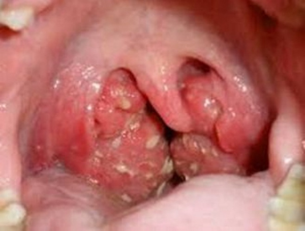 leptotrix oral