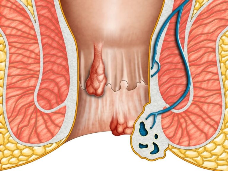 Remedii naturiste pentru hemoroizi